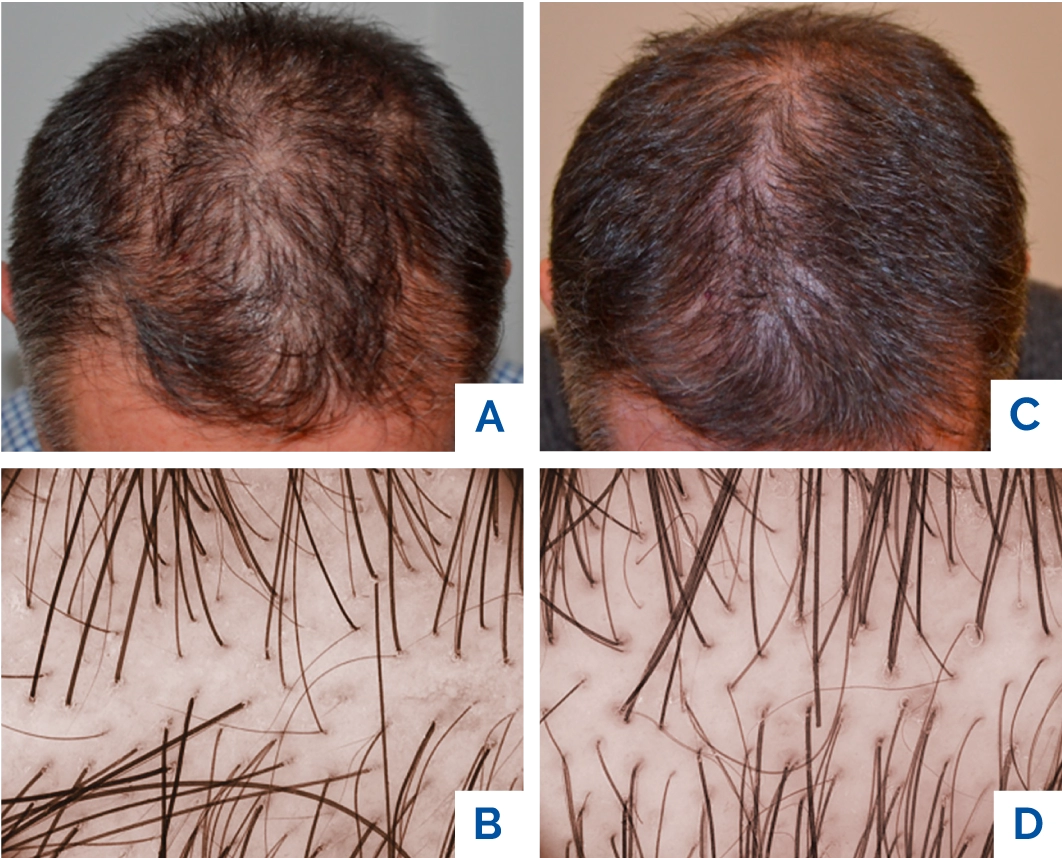 Muž před a po - Tricopat