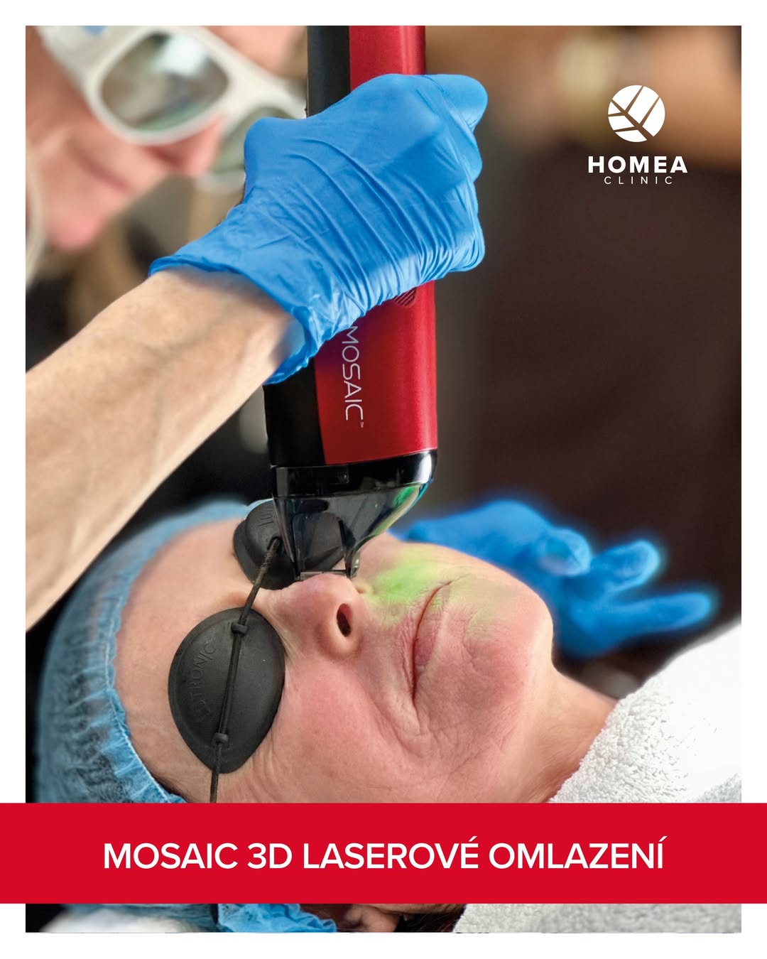 Mosaic 3D laserové omlazení