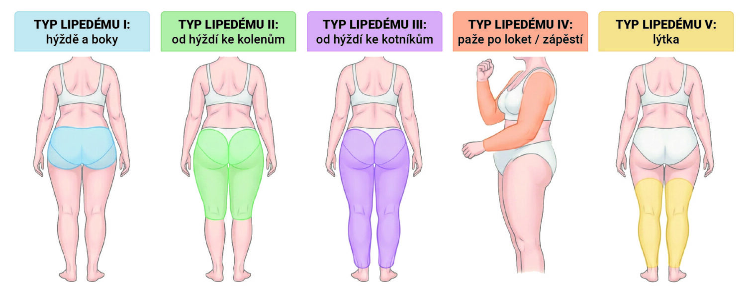 Typy lipedému